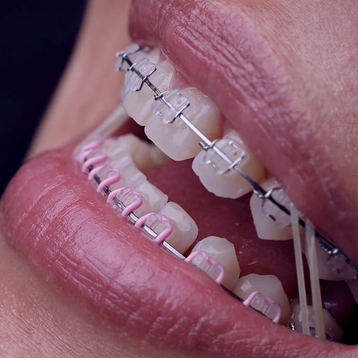 Металлические брекеты от 35 000 сом — установка со скидкой 5%